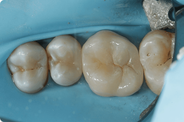 Isolation and cementation