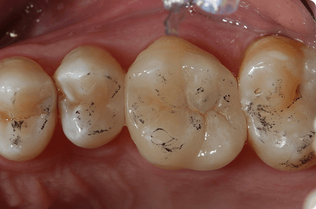 Post cementation adjustments